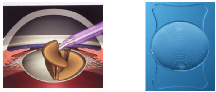 Intervento cataratta: facoemulsificazione