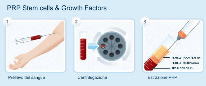 Collirio con Siero Autologo