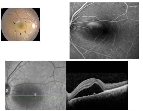 Diagnosi corioretinopatia sierosa