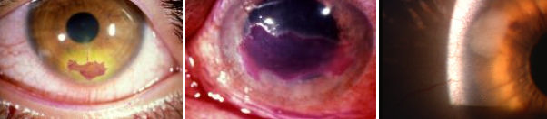 Tipi di ulcere corneali