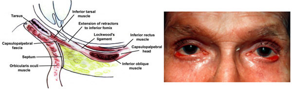 Anatomia ectropion palpebrale