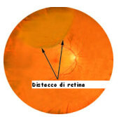 Aspetto globoso distacco di retina