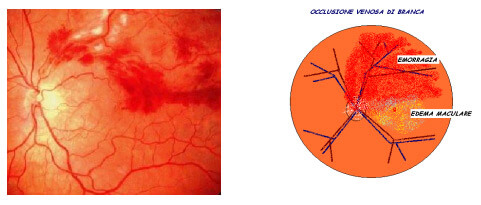 BRVO occlusione venosa di branca