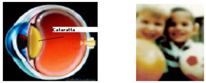 Cataratta nucleare - ingiallimento del cristallino