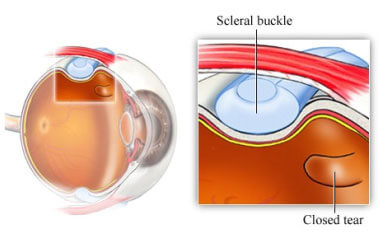 Chirurgia episclerale - operazione distacco della retina