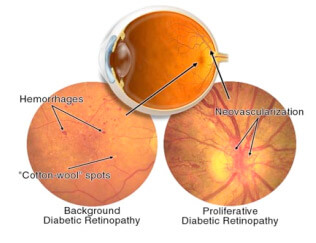 Confronto retinopatia diabetica proliferante e non proliferante