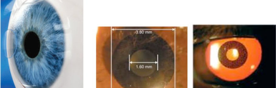 Correzione miopia laser