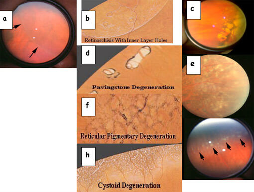 Degenerazioni retiniche fori e distacco di retina