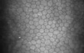Diagnosi cataratta - Microscopia confocale