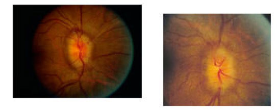 Diagnosi pseudotumor cerebri