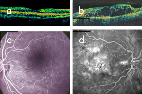 Esame oct retinopatia diabetica