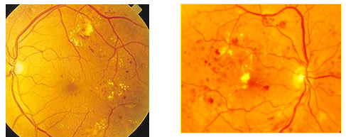 Fase iniziale retinopatia diabetica