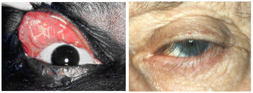 Floppy eyelid syndrome, palpebra lassa