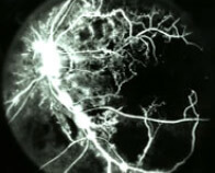 Fluorangiografia ischemia retinica