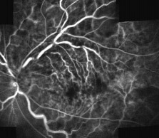 Fluorangiografia occlusione venosa di branca