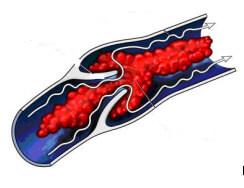 Formazione trombi occlusioni vascolari