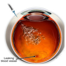 Iniezione intravitreale farmaci retinopatia diabetica