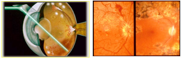 Intervento laser retinopatia diabetica