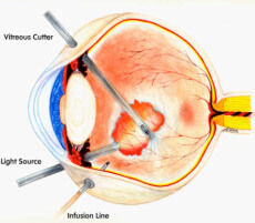 Intervento vitrectomia posteriore retinopatia