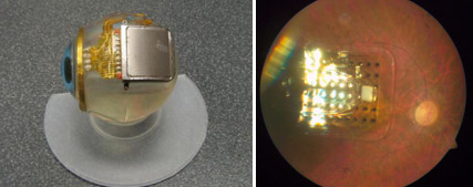 Microchip impianto retinico retinite pigmentosa