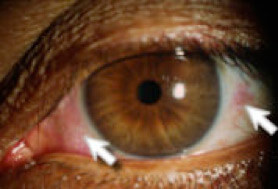 Occhio secco sintomi: bruciore occhi