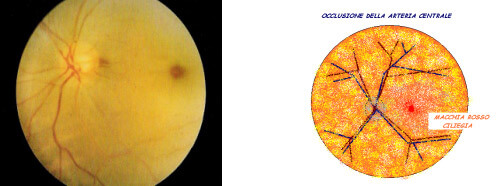 Occlusione arteriosa retinica