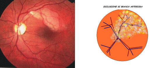 Occlusione branca arteriosa retina