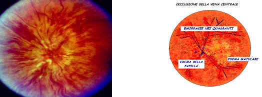 Occlusione vena centrale retina