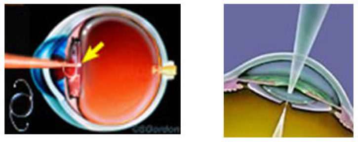 Operazione YAG laser cataratta