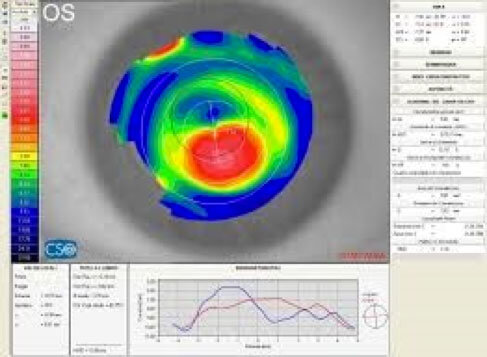 Diagnosi del cheratocono tramite tipografia corneale