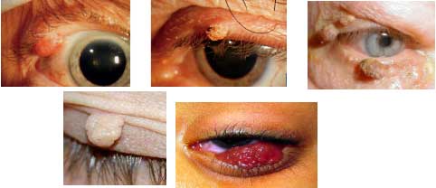 Papilloma virus e malattie autoimmuni, Papilloma virus all occhio
