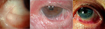 Pemfigoide oculare cicatriziale