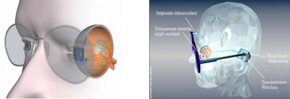 Telecamera occhiali retinite pigmentosa